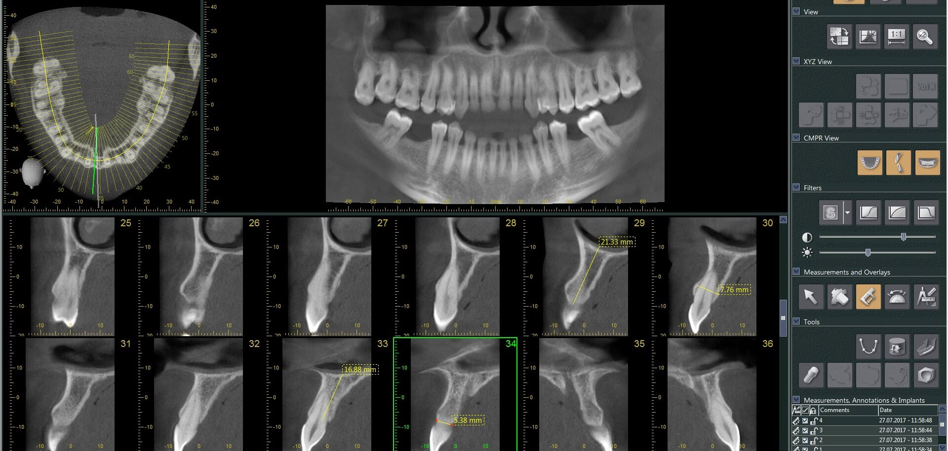 3D Çene ve Diş Tomografisi