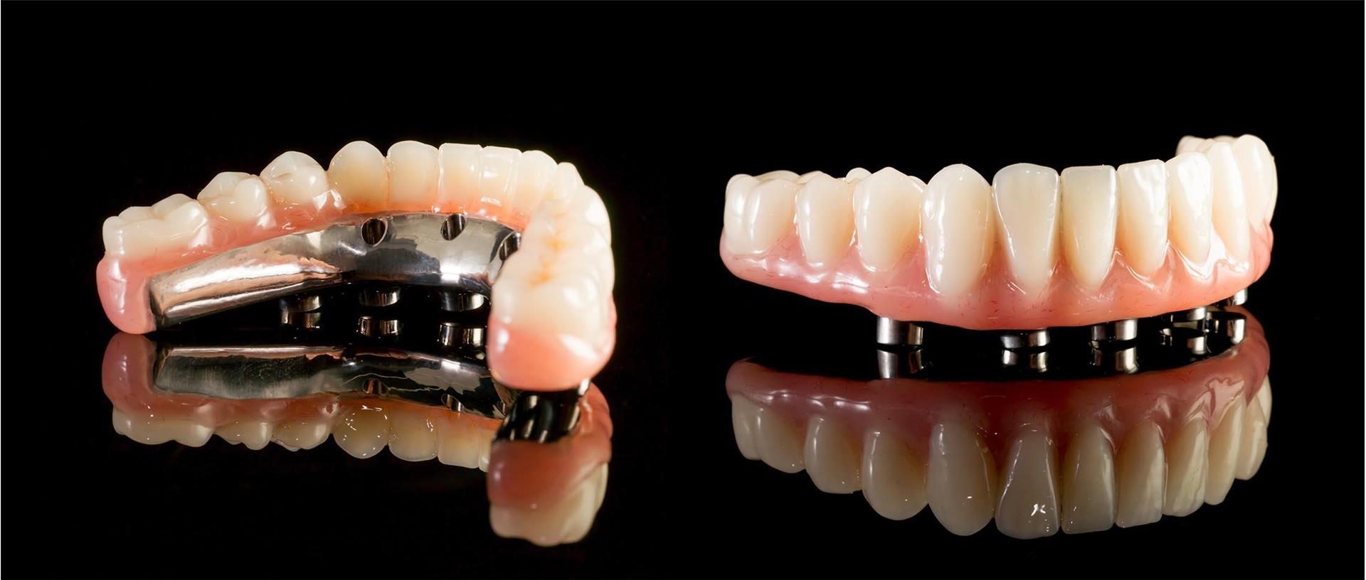 Hassas Bağlantılı Diş Protezleri