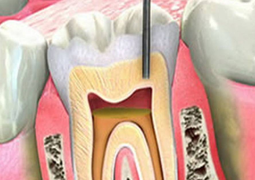 Endodonti